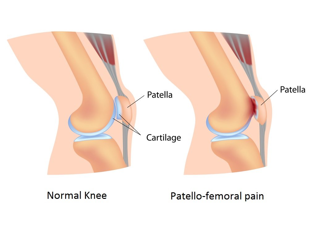 patellofemoral pain syndrome